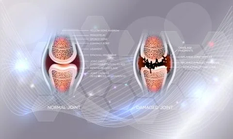 Damaged and normal joint Illustrazione stock