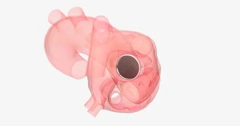 The damaged aortic valve may also be replaced with a mechanical or a biolog.. Stock Illustration
