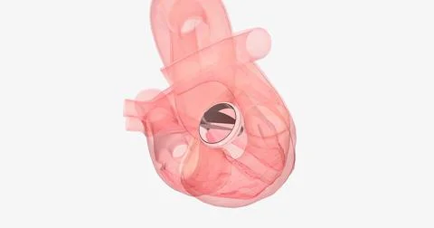 The damaged aortic valve may also be replaced with a mechanical or a biolog.. イラスト素材