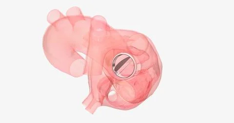 The damaged aortic valve may also be replaced with a mechanical or a biolog.. イラスト素材