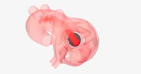 The damaged aortic valve may also be replaced with a mechanical or a biolog.. 스톡 일러스트