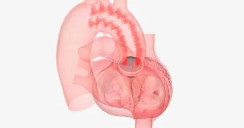 The damaged aortic valve may also be replaced with a mechanical or a biolog.. 스톡 일러스트