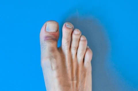 Damaged big toe on a blue background Fotos Stock