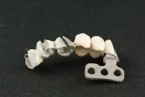 Damaged dental prosthesis Stock Photos