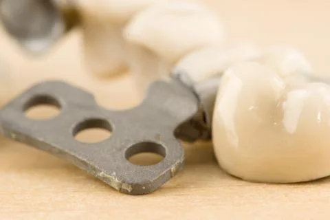 Damaged dental prosthesis Stock Photos