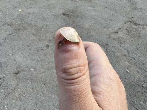 Damaged fingernail Stock Photos