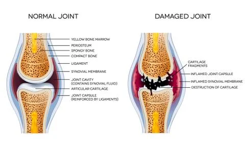 Damaged joint and healthy joint Stock Illustration