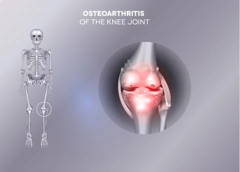 Damaged joint on a grey background. Stock Illustration