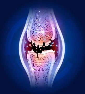 Damaged joint Stock Illustration