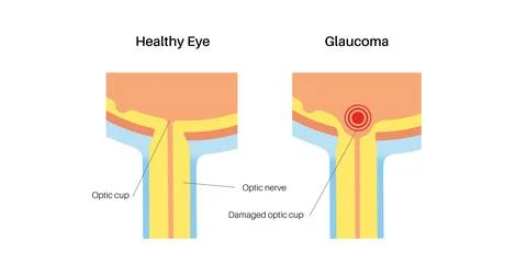 Damaged optic cup Stock Illustration