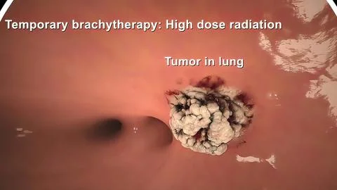 Damaged sick lungs. 3D render illustration for respiratory problems, cancer m Stock Illustration