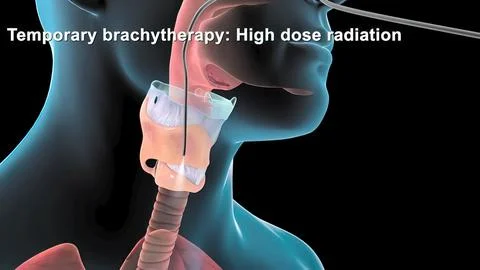 Damaged sick lungs. 3D render illustration for respiratory problems, cancer m Stock Illustration