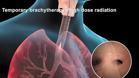 Damaged sick lungs. 3D render illustration for respiratory problems, cancer m Stock Illustration