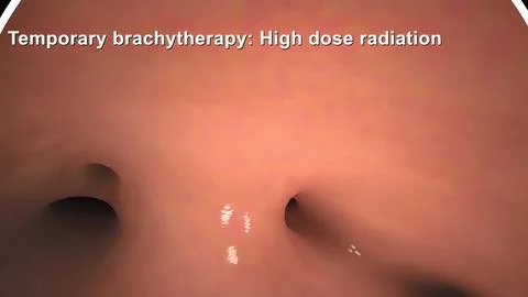 Damaged sick lungs. 3D render illustration for respiratory problems, cancer m Stock Illustration