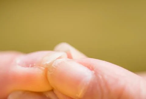 Damaged womans nail close up Stock Photos