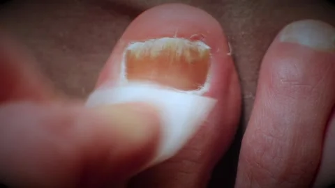 Damp paper towel cleans infected big toe nail and skin Video stock 267272753