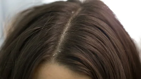 Dander that causes itching scalp Stock Footage 68403121