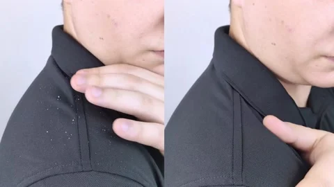 Dandruff before and after. The man on the left shows his shoulder, which has a l Stock Footage 149733105