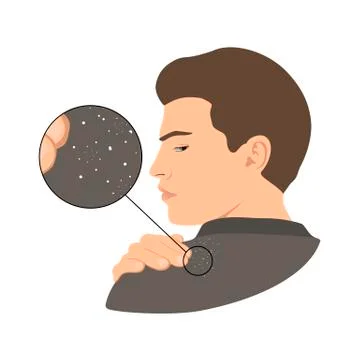 	Dandruff issue on man s shoulder Stock Illustration