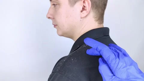 Dandruff on a man's shoulder. Side view of a man who has more dandruff flakes on Stock Footage 149733099