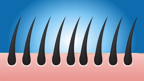 Dandruff stages vector , closeup on skin and dandruff ( black hair ) Stock Footage 85969903