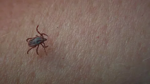 Dangerous vector Hard tick on human skin. Stock Footage 195175616