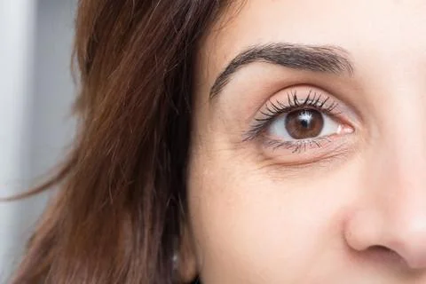 Dark circles under eye of young beautiful woman Fotos de archivo