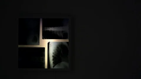 A dark room lights up the x-ray lamp pictures. the x-ray images show the chest Stock Footage 91667470