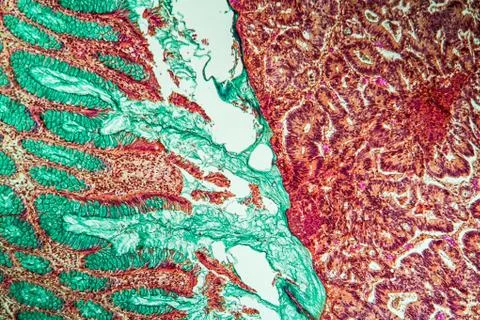 Darmkrebs 스톡 사진