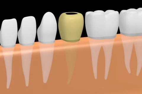 Decayed/ rotten tooth Stock Illustration