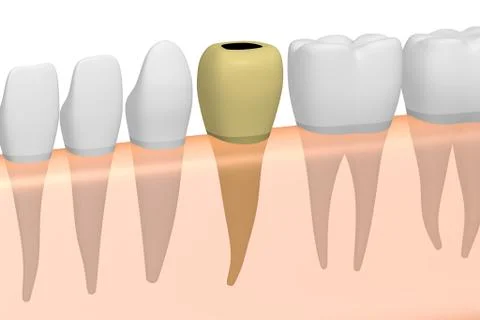 Decayed tooth Stock Illustration