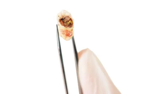 Decayed Tooth Stock Photos