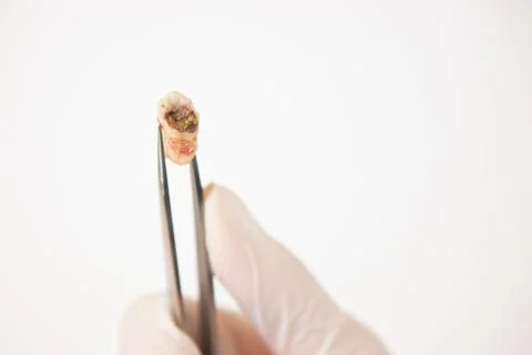 Decayed Tooth Stock Photos