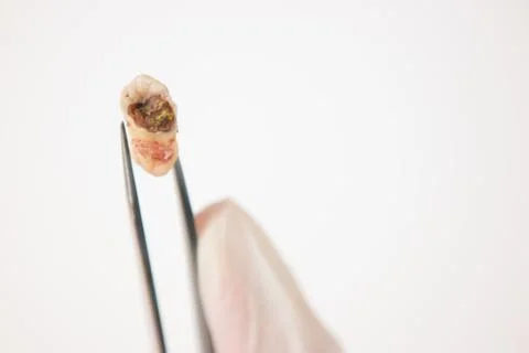 Decayed Tooth Stock Photos