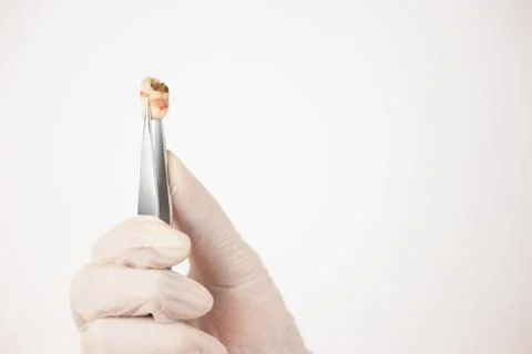 Decayed Tooth Stock Photos