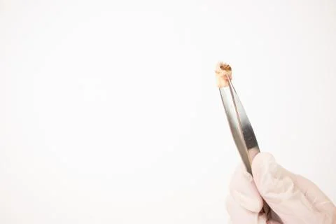 Decayed Tooth Stock Photos