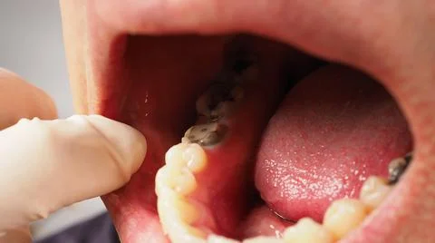 Decayed tooth root canal treatment. Tooth or teeth decay of lower molar. Stock Photos
