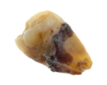 Decayed wisdom tooth Stock Photos