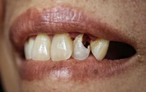 Decaying maxillary teeth Stock Photos