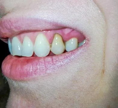 Decaying woman's tooth changing it's color 스톡 사진