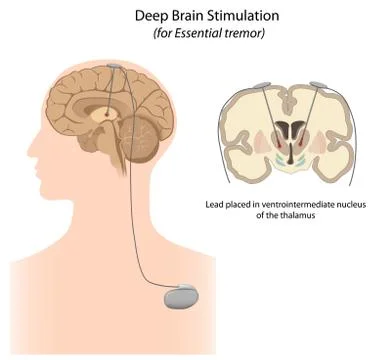 Deep brain stimulation for essential tremor Stock Illustration