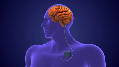 Deep brain stimulation medical concept Stock Footage 254071287