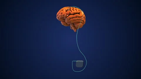 Deep brain stimulation as a medical concept Stock Footage 273490169