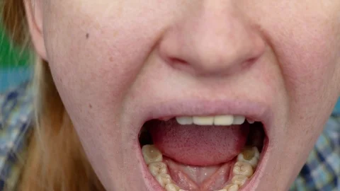 Deep caries, open canals, cleaning canals. Patient at stomatolon on admission, p Stock Footage 98572290