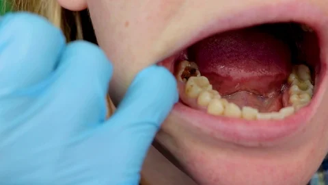 Deep caries, open canals, cleaning canals. Patient at stomatolon on admission, p 스톡 동영상 98572333