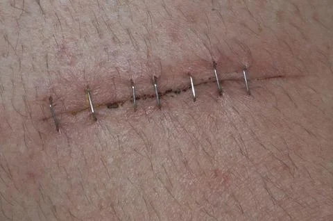Deep cut with several staples to facilitate healing Stock Photos