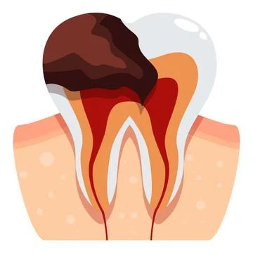 Deep tooth decay affecting enamel, dentin, pulp, and root canal イラスト素材