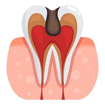 Deep tooth decay causing pulpitis and gum inflammation イラスト素材