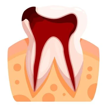 Deep tooth decay showing pulp and root canal イラスト素材