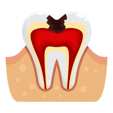 Deep tooth decay showing pulp and root canal inflamation イラスト素材